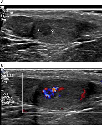 Indeterminate Lesions of the Testis in Klinefelter Syndrome—Should We Be Concerned?